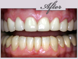 new york teeth whitening